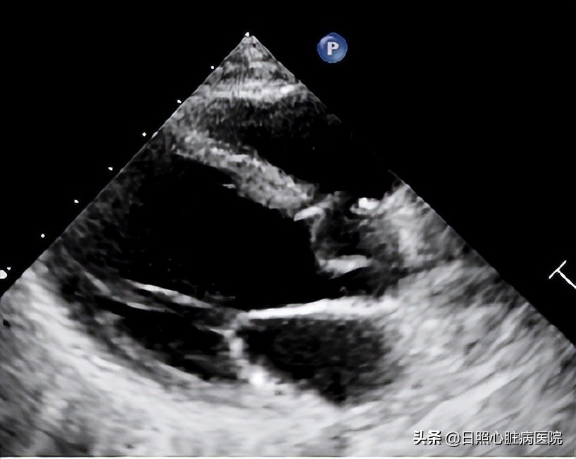 心脏室间隔缺损不治疗行吗,心脏有个洞要补吗