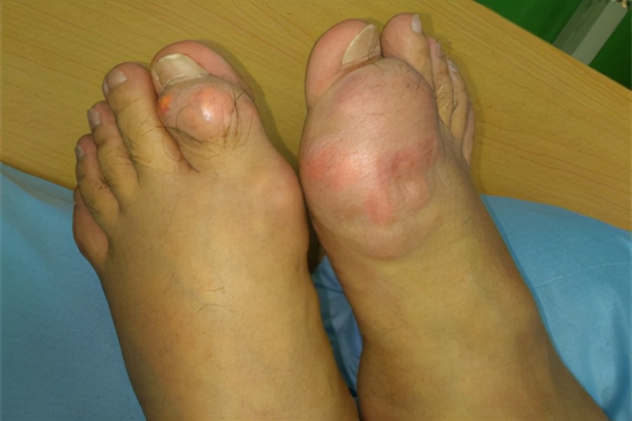 痛风是怎么引起的怎么样预防痛风,痛风一定要忽视吗