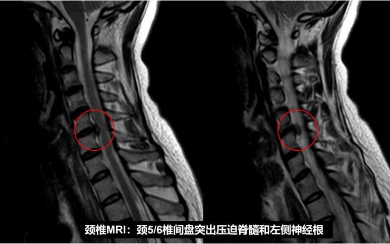 手痛手麻手僵硬是什么原因,手麻引起手指中节疼是什么原因