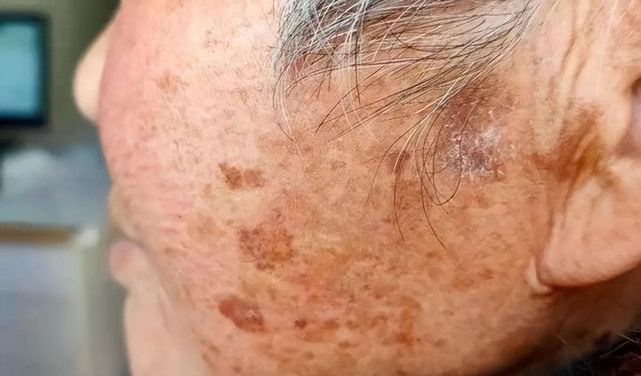 红霉素软膏可以去除老年斑么,红霉素软膏能够去除老人斑