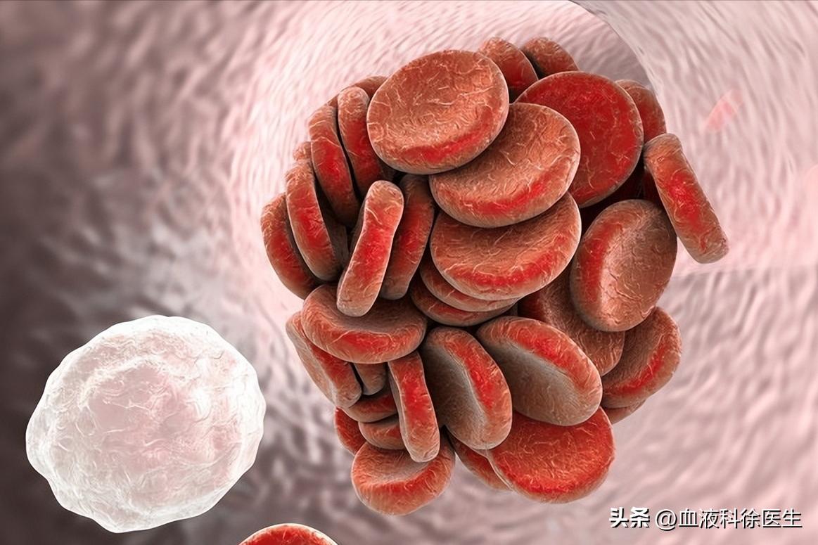 为什么脑血栓都是赌博惹的祸,为什么得了脑血栓会反复发高烧