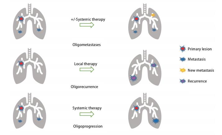 非小细胞肺癌患者的放射治疗,寡转移非小细胞肺癌术后辅助治疗