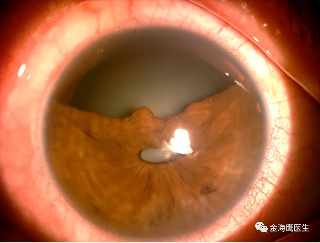同济大学附属上海东方医院金海鹰教授：巩膜层间缝纫机技术要点