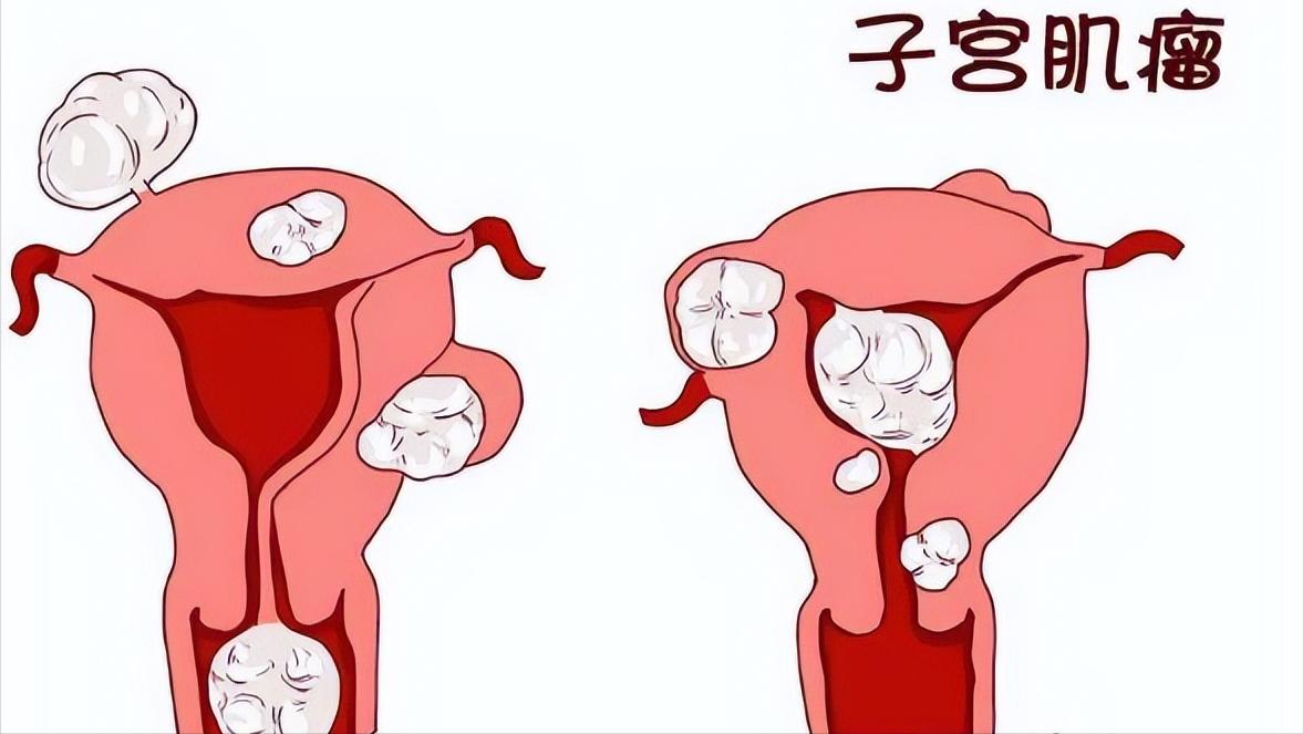 女性没了子宫之后和正常人有什么区别？身体的变化，让你无法忽视