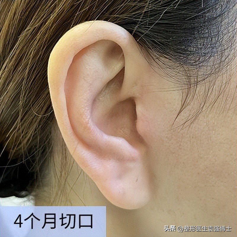 做拉皮恢复期太难熬,拉皮手术的十大问题