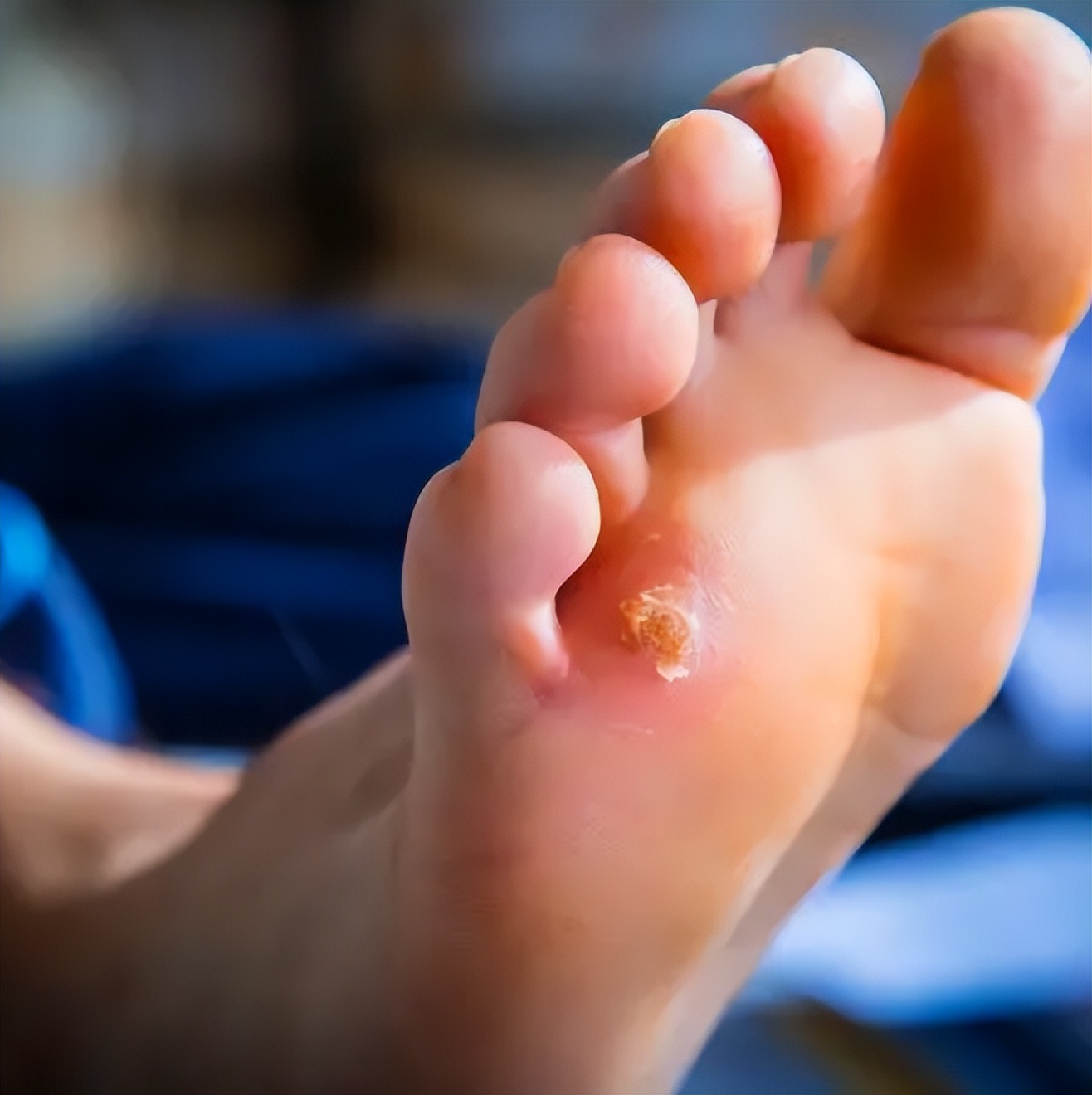 脚气真菌怎么治才能除根,脚气真菌怎么彻底消灭