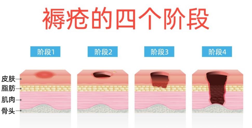 得了很严重的褥疮老人能活多久,老人得了褥疮可以吃鸡蛋吗
