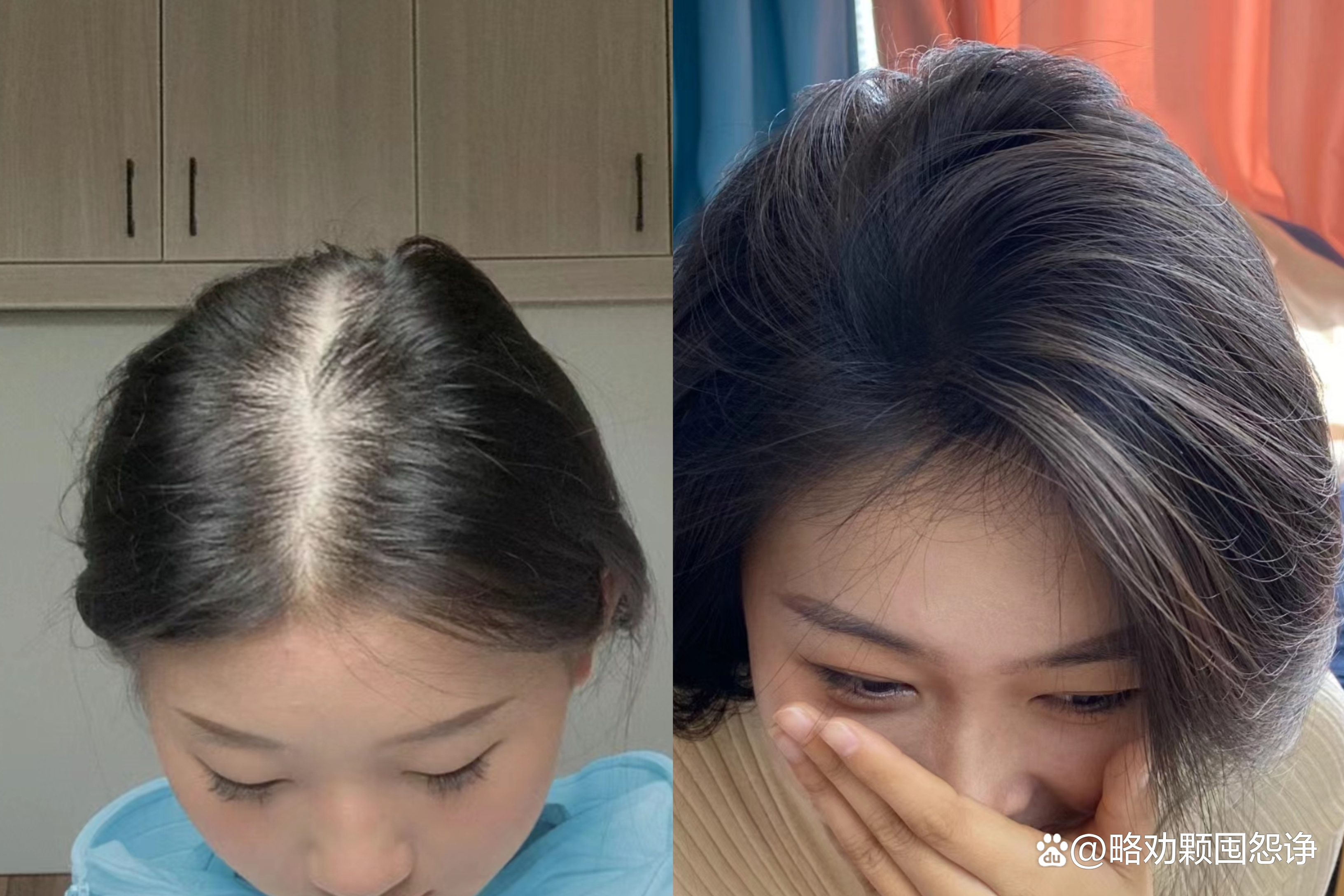 不用花钱就能快速消除头屑,解决脱发不用洗发水