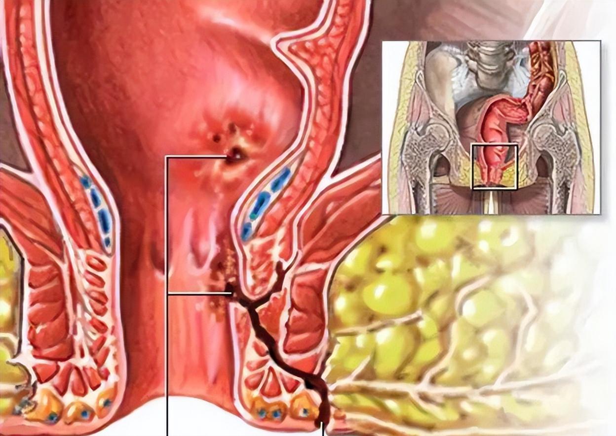 中医肛痈的主要病因在于,肛痈的临床表现及证型