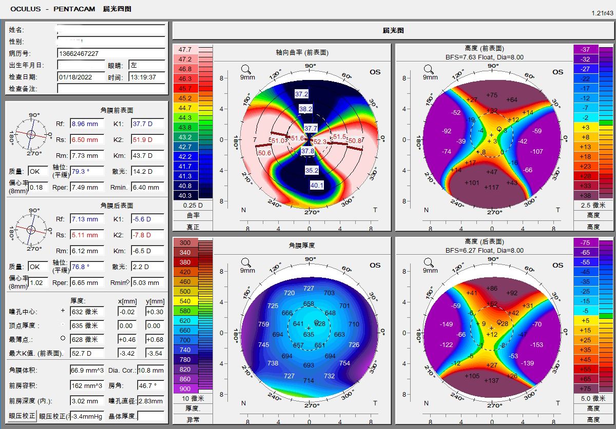 从“睁眼瞎”到正常视物——1600度超高度散光患者的视觉重建之路