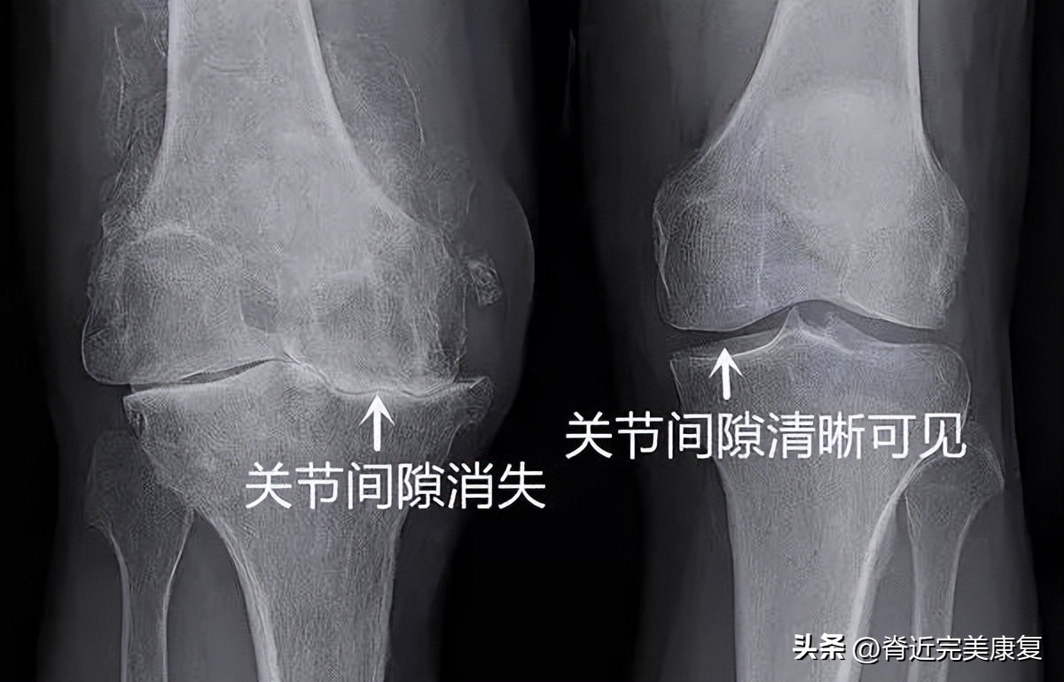 关节炎需要补钙还是吃软骨素,骨关节炎补充软骨素叫啥名