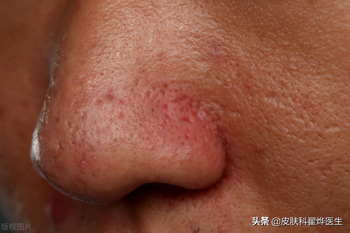 幽门螺旋杆菌与哪些皮肤病有关,幽门螺杆菌会引起皮肤病吗