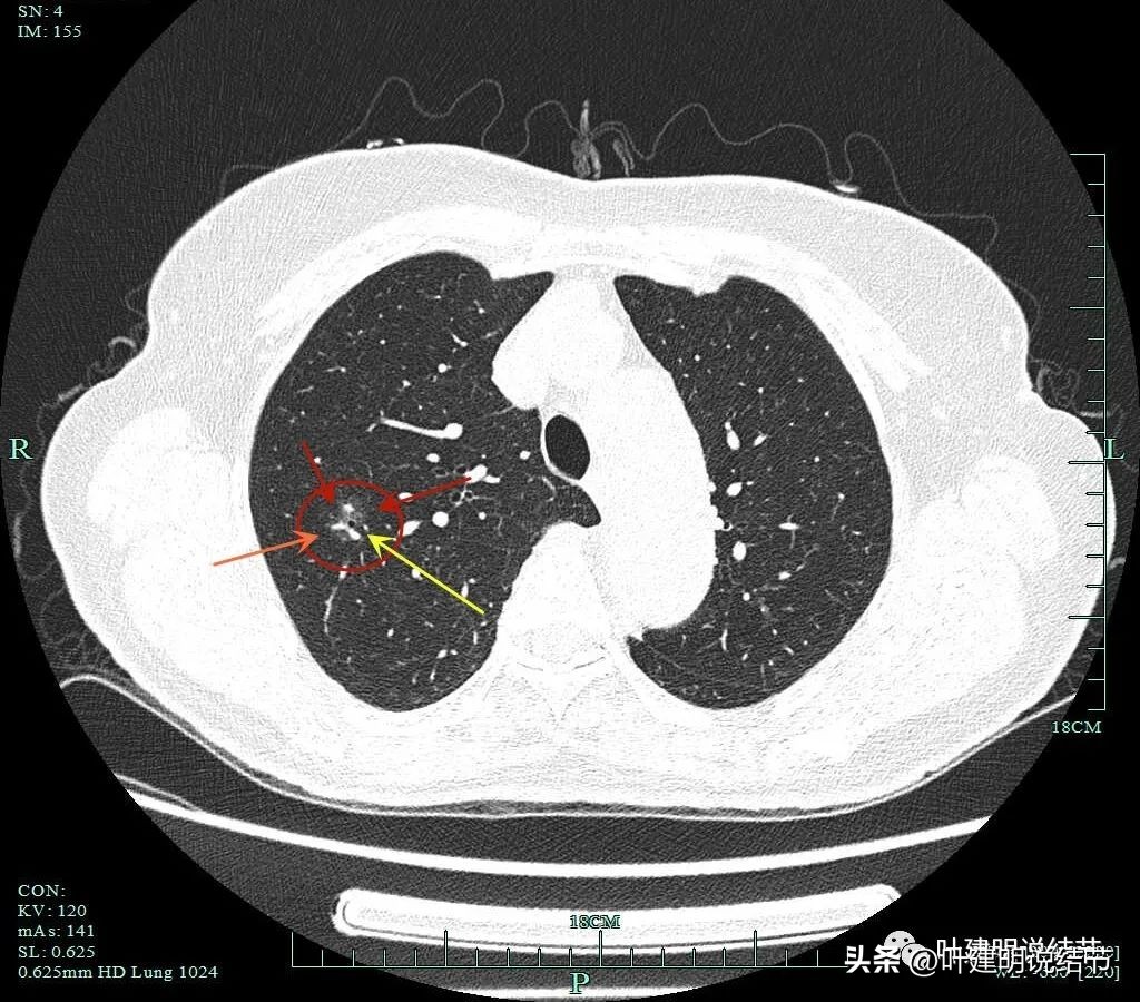 肺楔形切除肺功能降低,肺楔形切除需要缝合吗