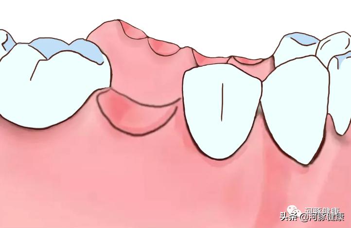 刷牙时牙龈出血要警惕,刷牙时牙龈出血牙膏会进入血液吗