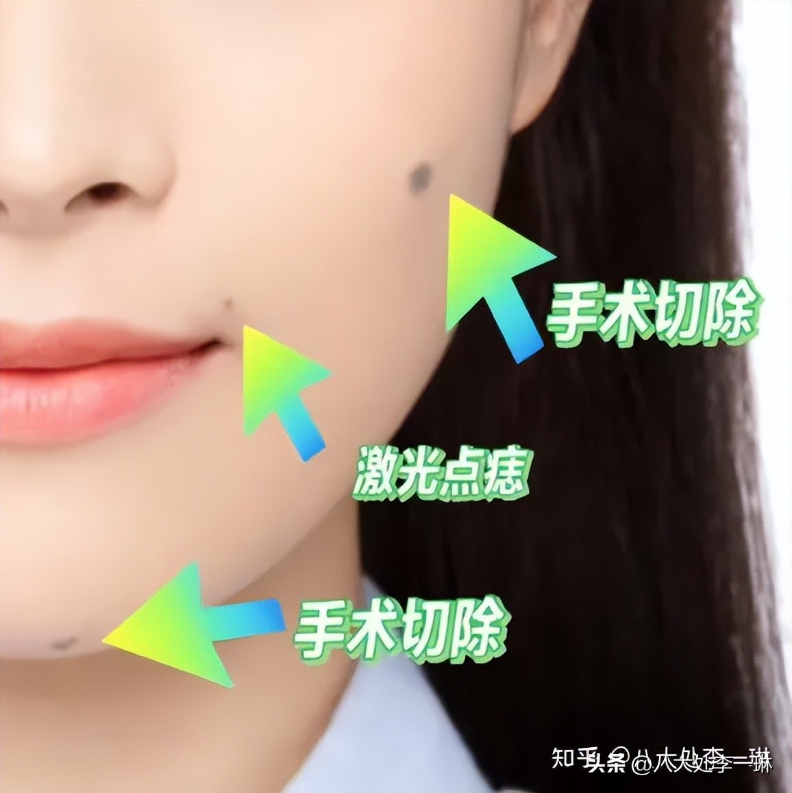 无色素痣怎么去除最好,什么是色素痣