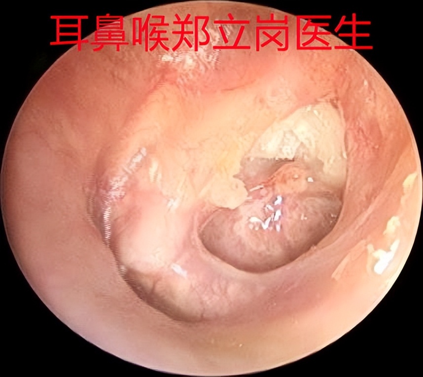中耳炎手术失败案例,郑立岗中耳炎微创手术