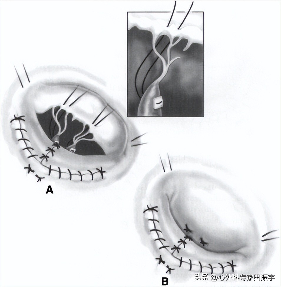 二尖瓣成形术,二尖瓣成形术后需要静养多久