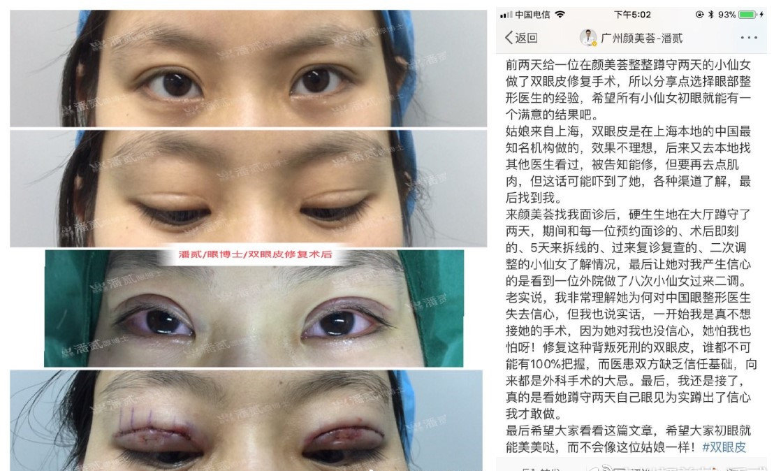 在整形医院割双眼皮多少钱,整形一般做双眼皮多少钱