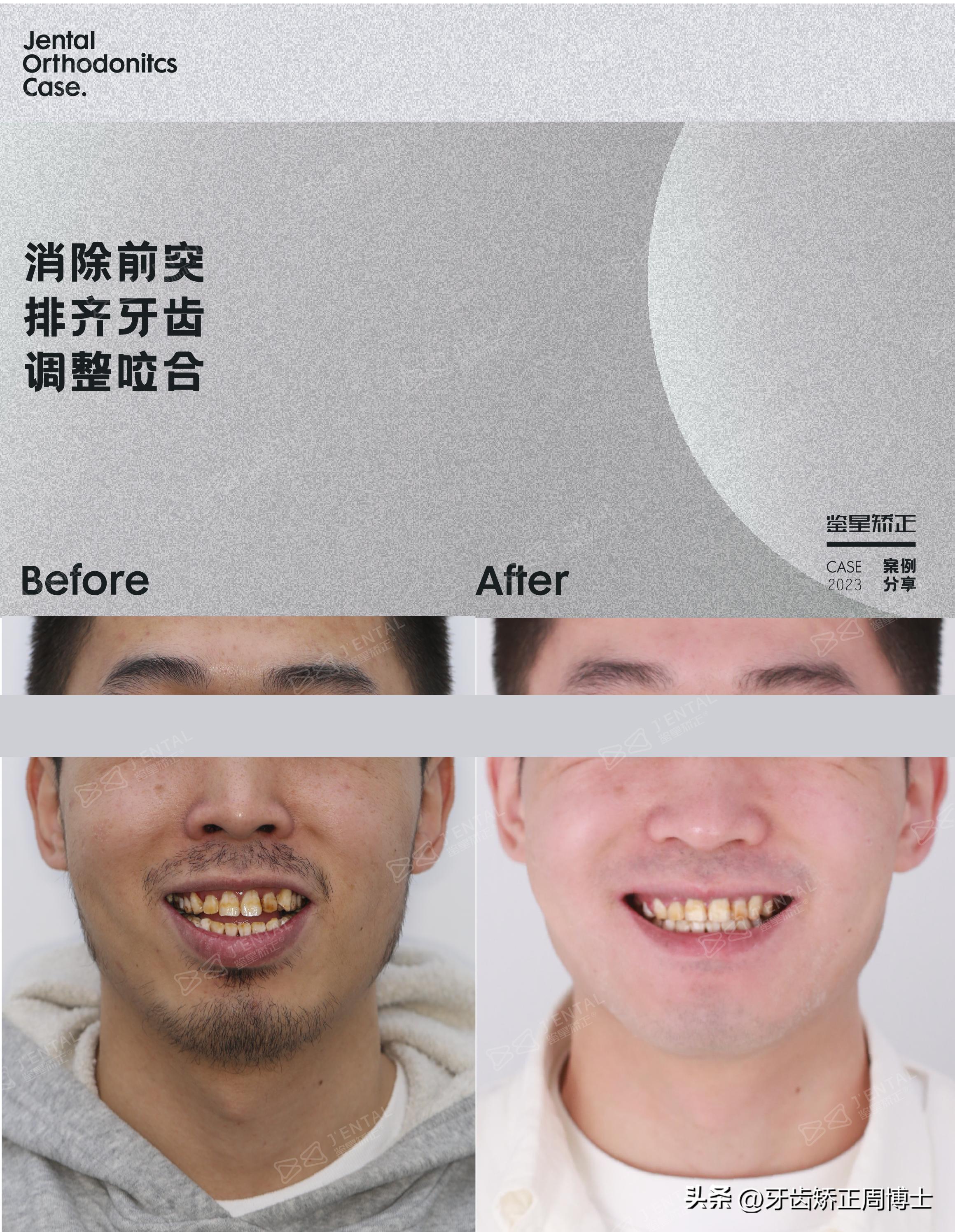 智齿正畸替代第二磨牙危害,智齿矫正代替第二磨牙3d图