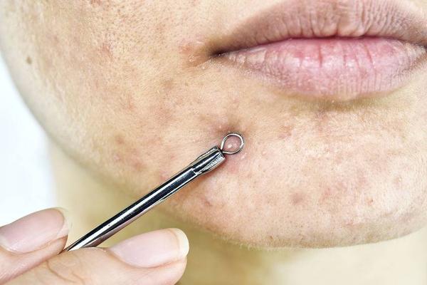 脸上经常长痘是什么原因怎么治疗,脸上反复长痘该如何解决