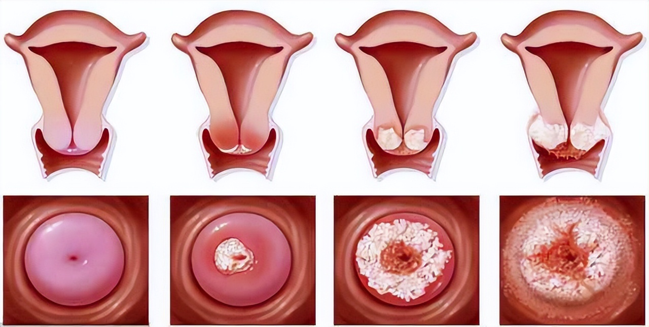 宫颈癌初期没有任何症状吗,宫颈癌早期一点症状都没有