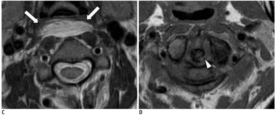颈长肌腱炎影像表现,三头肌钙化性肌腱炎治疗