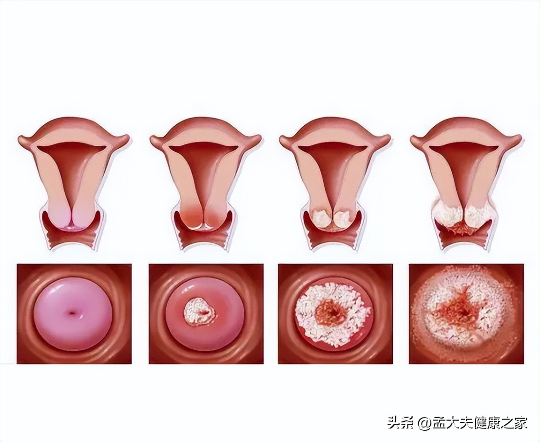宫颈肥大的原因和危害严重吗,检查宫颈肥大是怎么回事