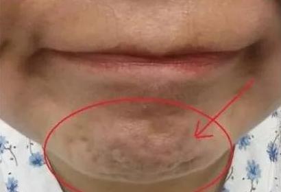 自体脂肪填充下巴缺点,假体加自体脂肪填充下巴图片
