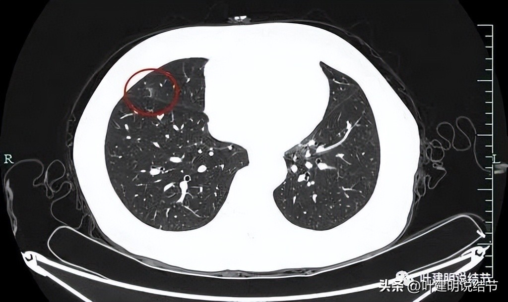 辽宁省肺结节手术哪家医院好,辽宁肺结节手术医院