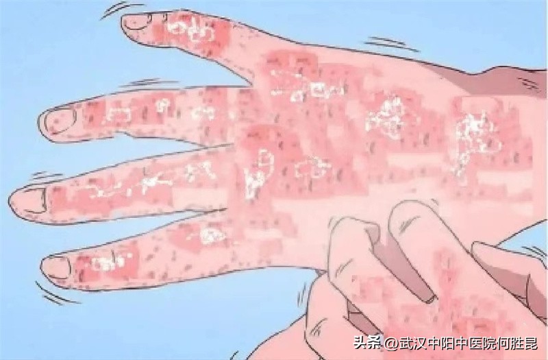 身上皮炎湿疹处突然奇痒怎么办,湿疹奇痒难忍怎么止痒