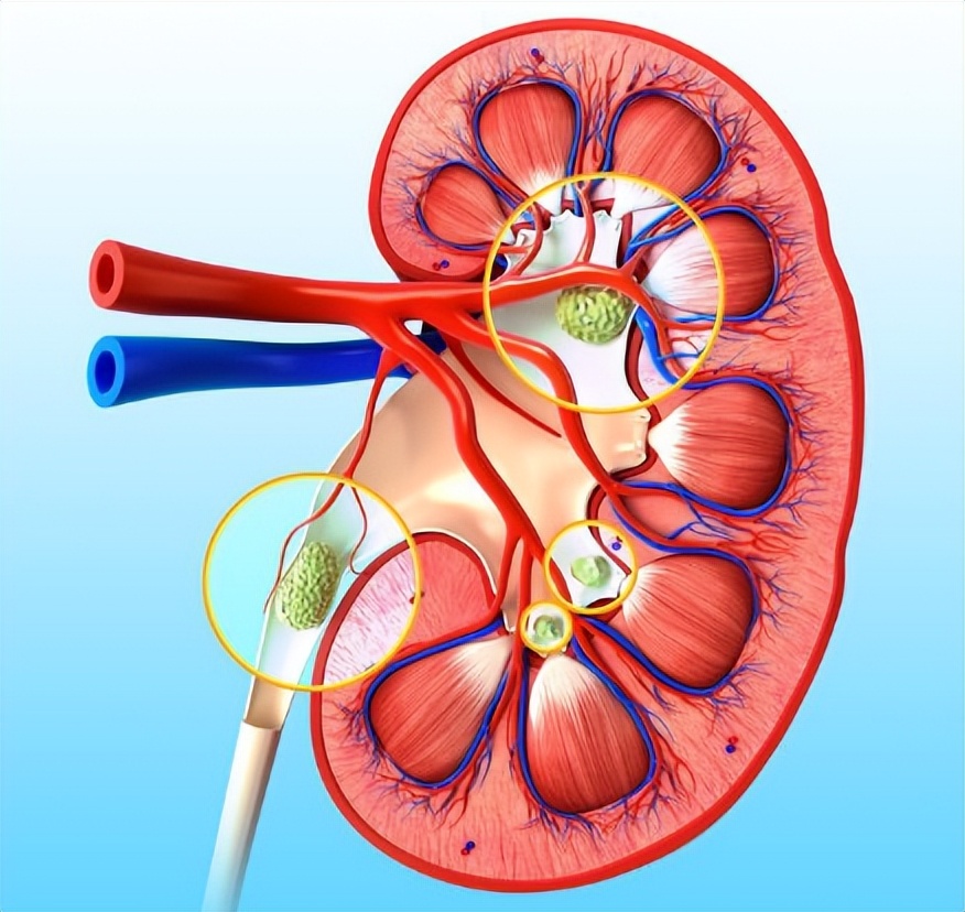 肾结石是不是经常发作,肾结石有石头不痛要治吗