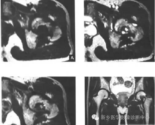 长骨膨胀性病变,长骨偏心性膨胀性病变