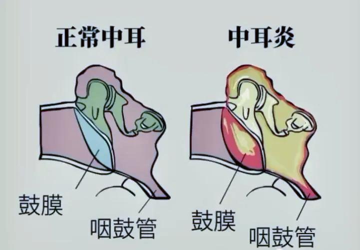急性中耳炎耳朵疼怎么快速止痛,4岁儿童急性中耳炎耳朵发红