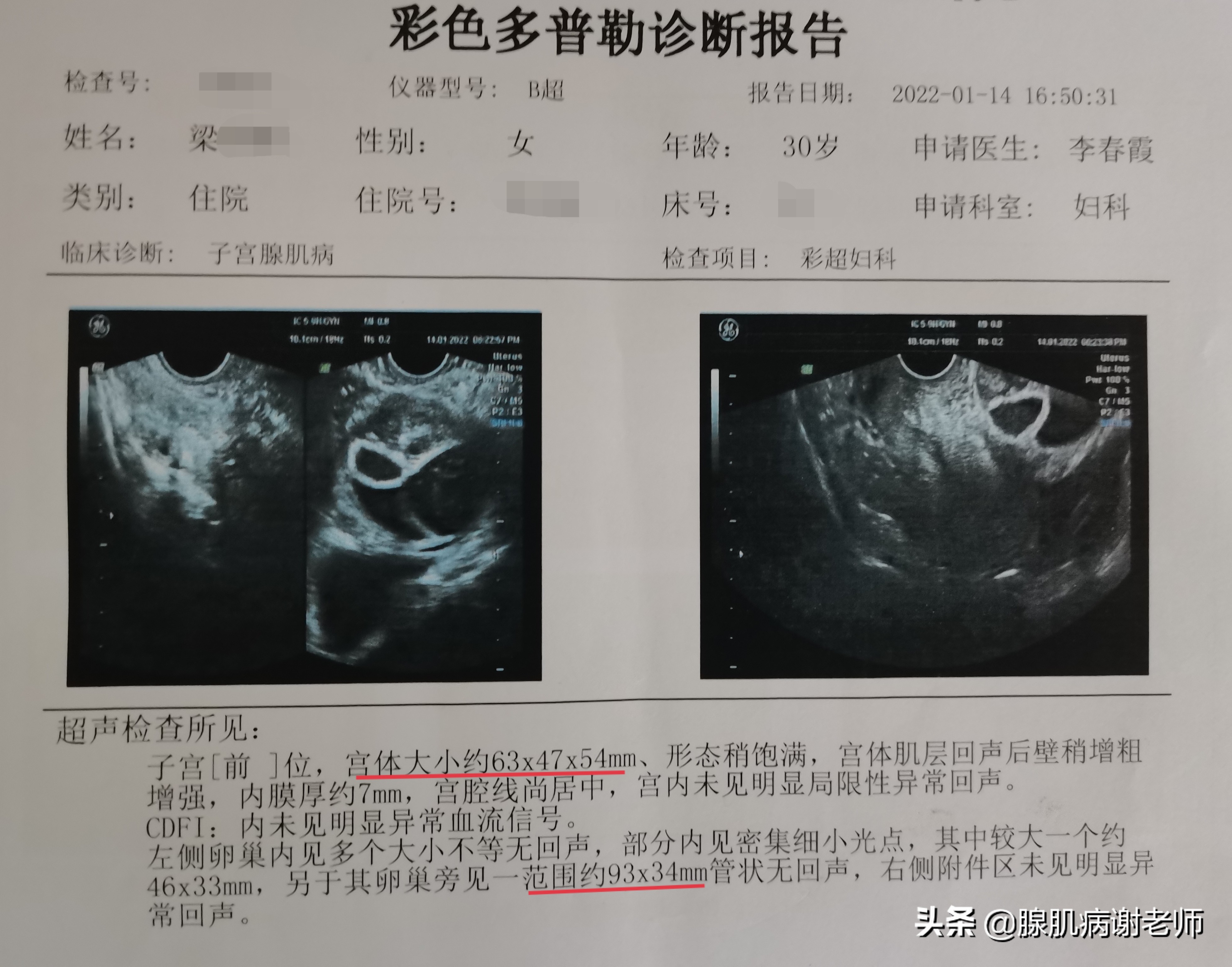 腺肌症排卵期像来月经一样痛,腺肌症是不是快来月经开始痛