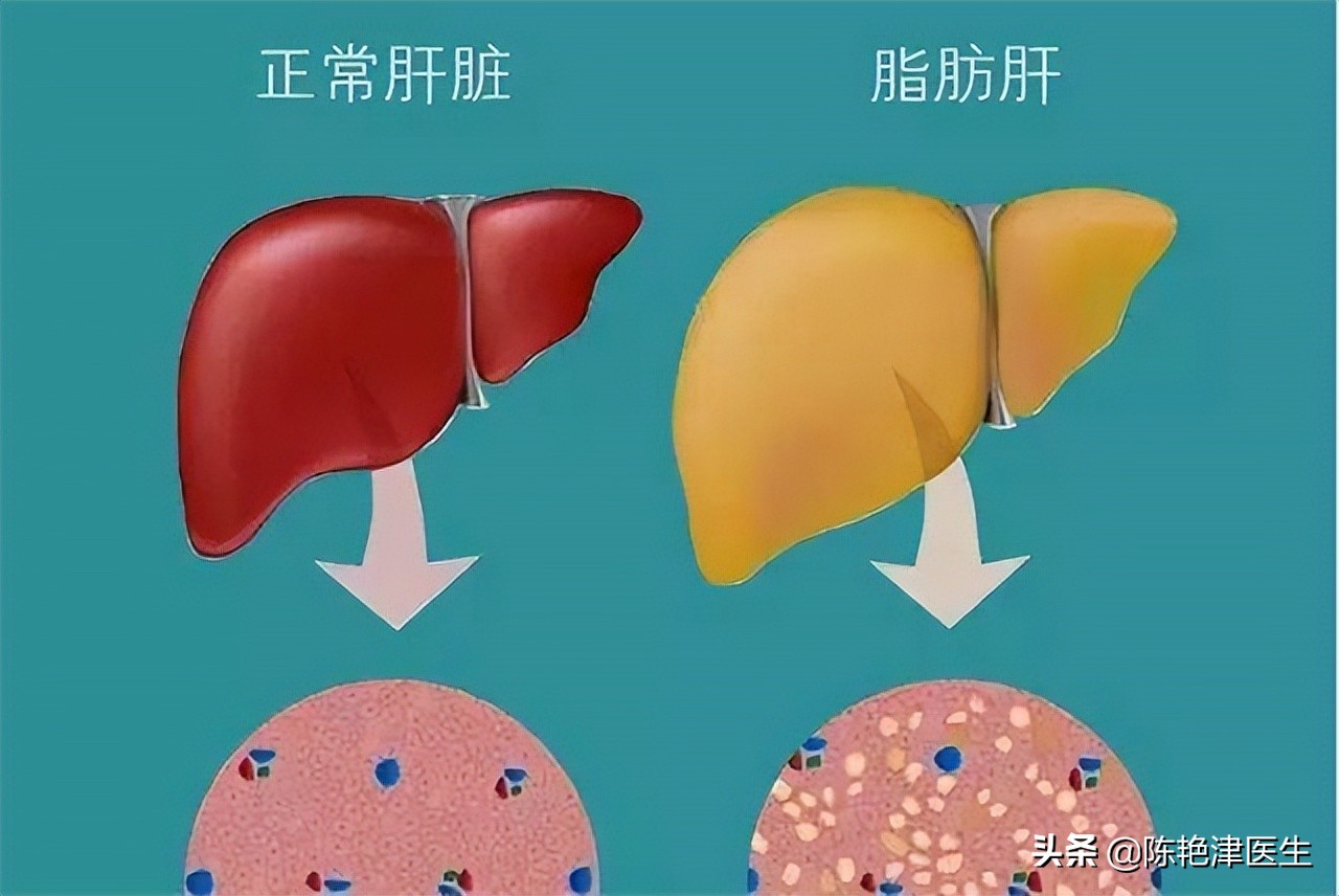 医生测血脂,医生一步一步教您看血脂