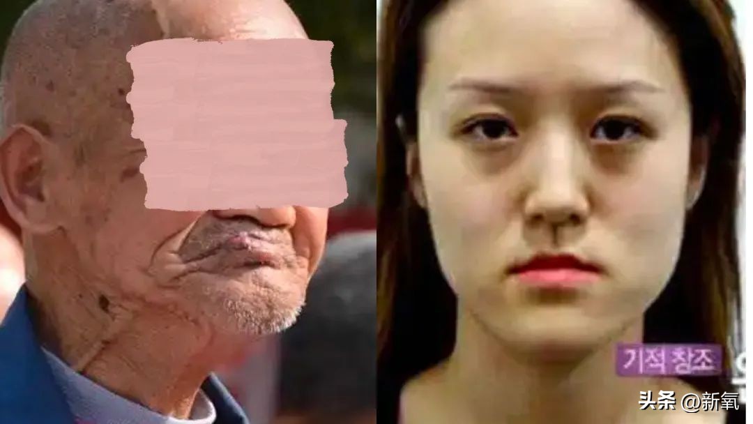 牙齿正畸和骨骼正畸的区别,牙齿正畸和眼轴增长有关系吗