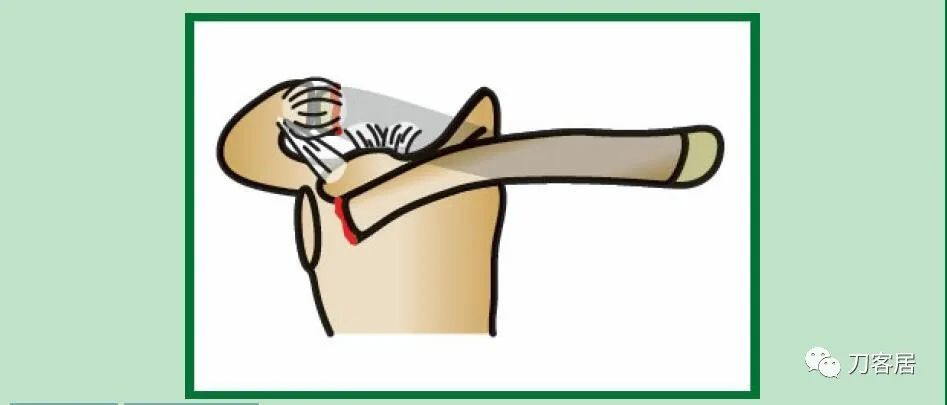 儿童锁骨骨折保守治疗的弊端,锁骨粉碎骨折错位不处理会愈合吗