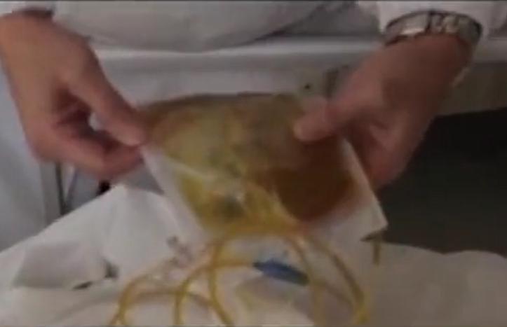 故事：湖北55岁男子病从口入，孕出成千上万虫卵，肚子竟成虫窝