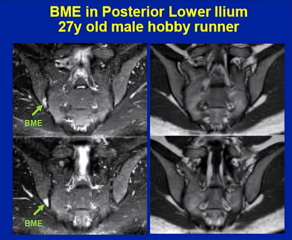 骶髂关节骨髓水肿最好的治疗方案,骶髂关节炎是脊柱关节病的一种吗