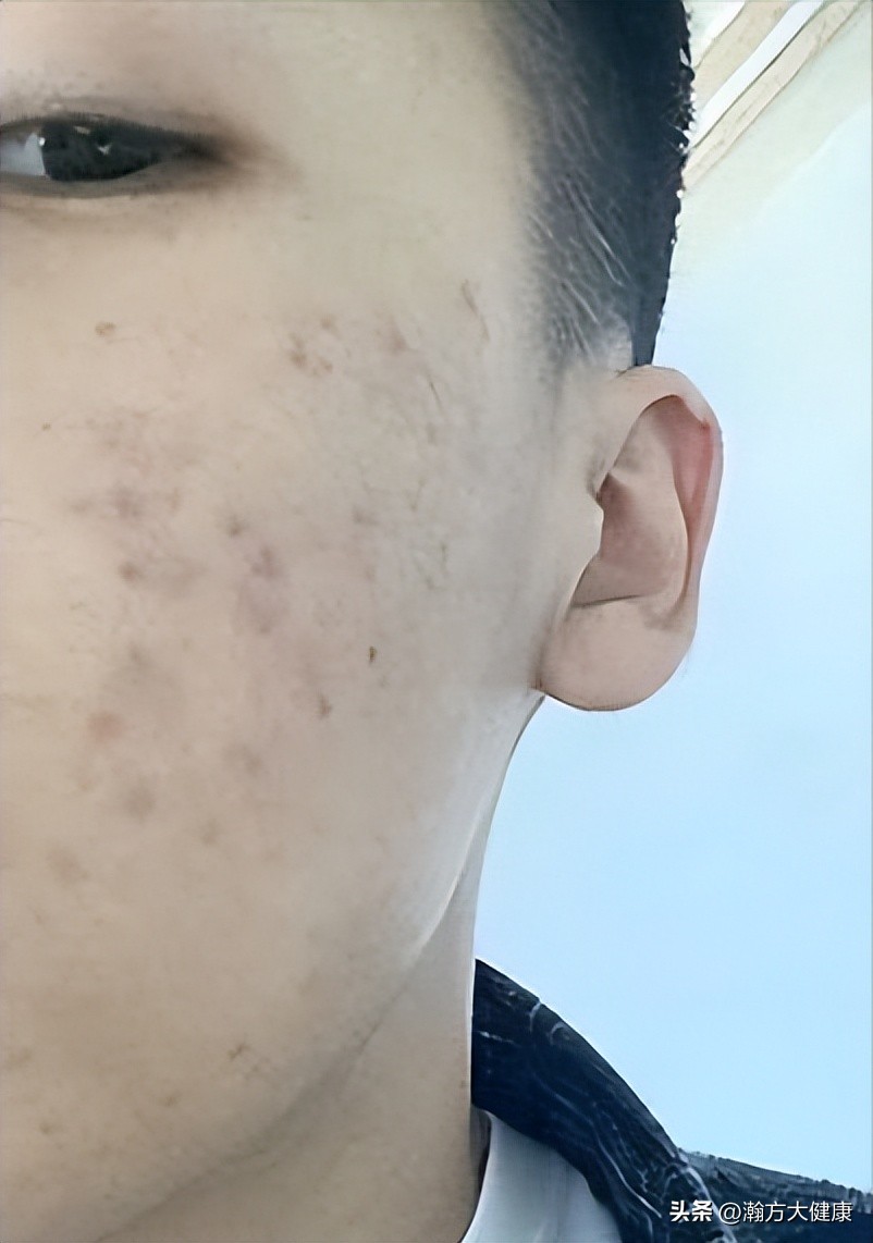 中草药治疗疤痕疙瘩良方,疤痕体质用什么方式祛黑痣