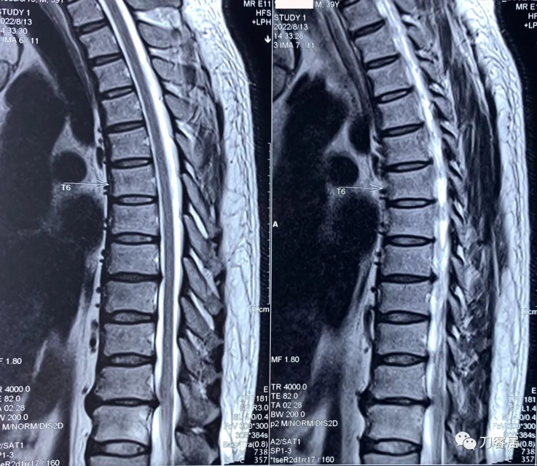 良性单侧下肢肌萎缩,下肢肌肉萎缩24年能治好吗