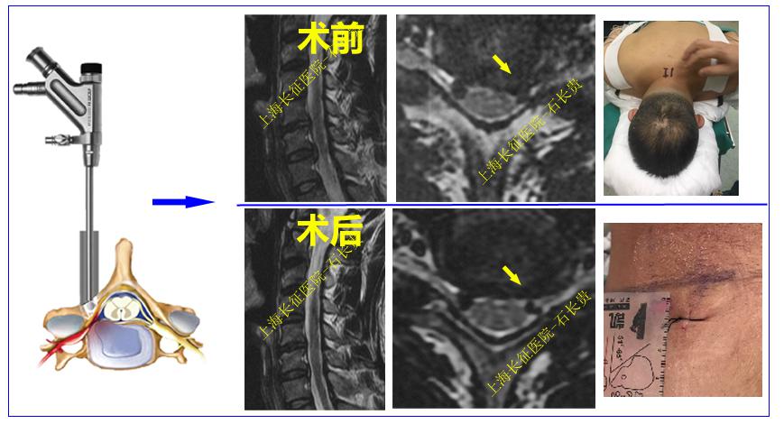 颈椎病是什么病要怎么治,颈椎病是怎样的症状
