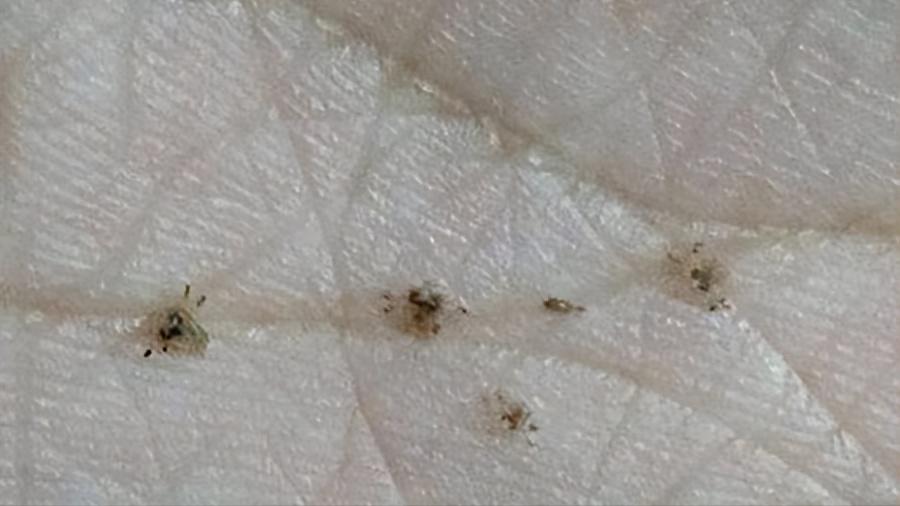 男子腹部痒,男子腹痛难忍夹出8条活虫