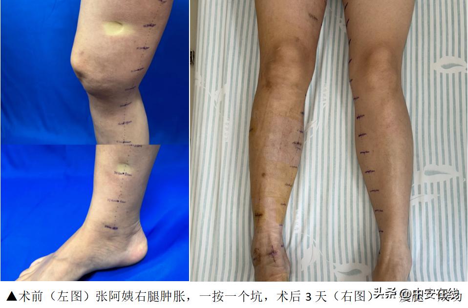 淋巴管堵塞下肢肿胀怎么办,淋巴管阻塞哪里治