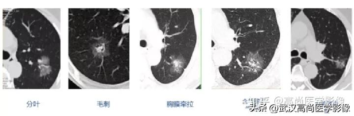 10毫米的肺结节恶性死亡率有多大,1厘米多的肺结节良性可能性多大