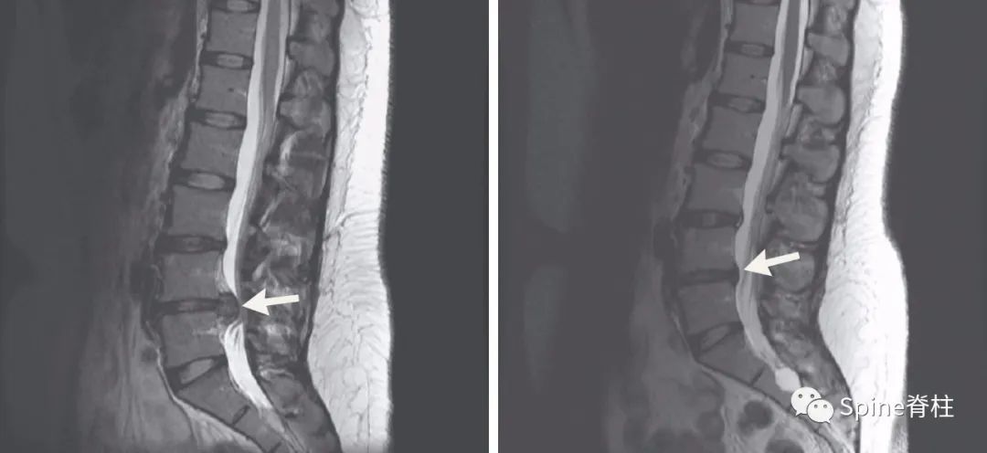 腰椎间盘突出症的治疗方法,腰椎间盘突出症状主要有哪些