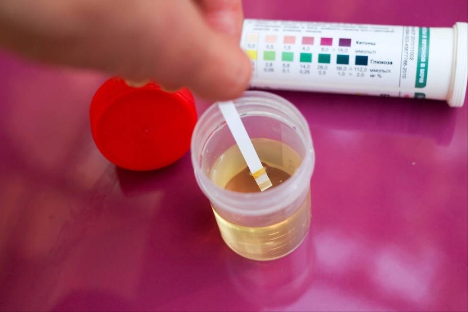 尿常规中尿蛋白加号对照表,尿蛋白出现加减号什么原因