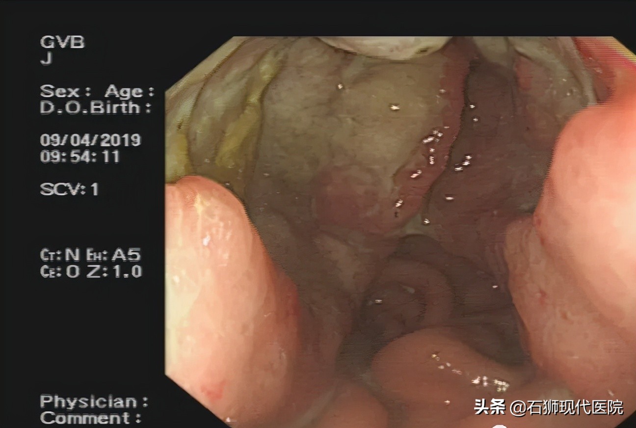 有哪些人不合适做胃镜,石狮市医院做胃镜肠镜技术可以吗