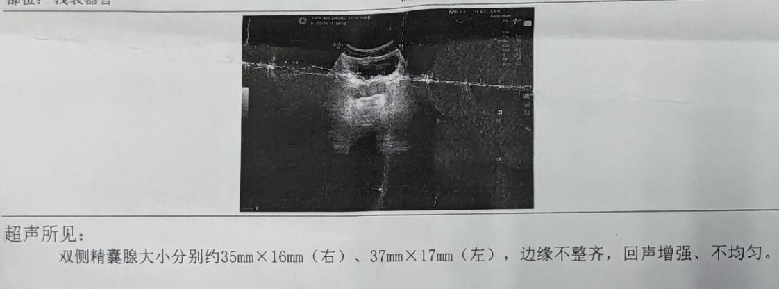 “精中带血，无出｜精｜痛”——精囊炎患者的治疗与注意事项