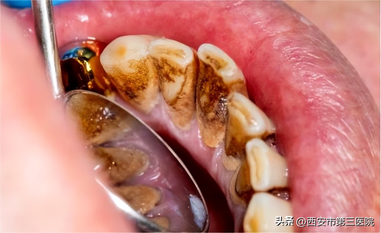 口臭咽喉不适,口臭口腔莫名不舒服还有点苦